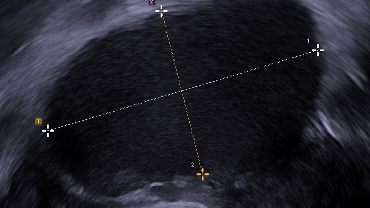 Transvaginal ultrasound showing an endometrioma, a cyst formed by endometriosis